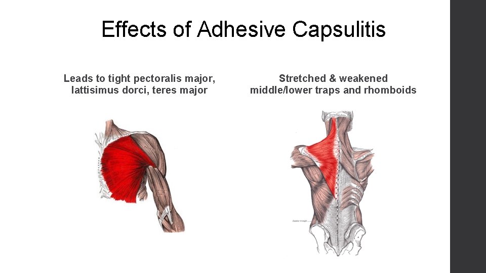 Effects of Adhesive Capsulitis Leads to tight pectoralis major, lattisimus dorci, teres major Stretched