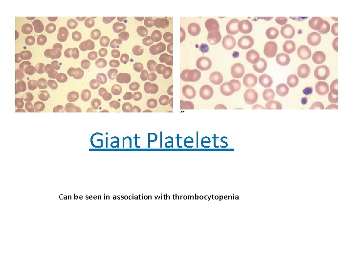 Giant Platelets Can be seen in association with thrombocytopenia 