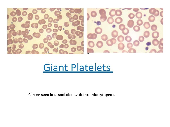 Giant Platelets Can be seen in association with thrombocytopenia 
