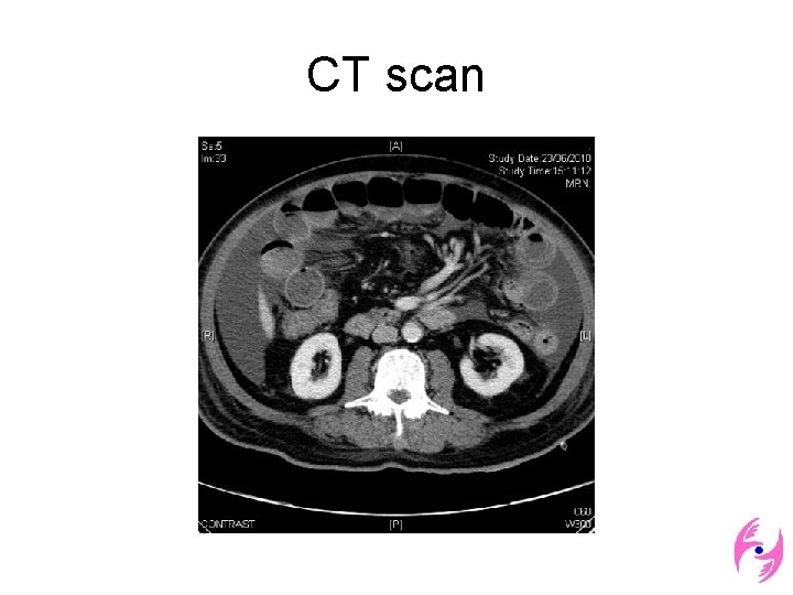 CT scan 