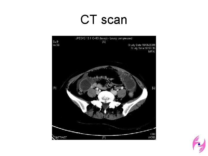 CT scan 