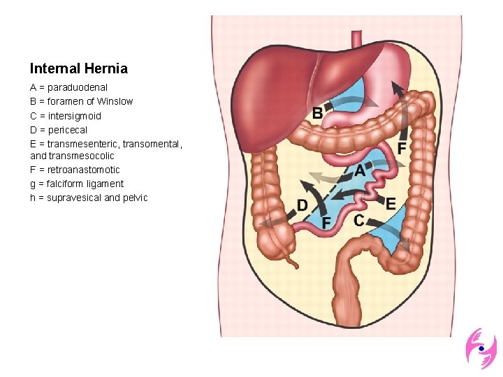 Internal Hernia A = paraduodenal B = foramen of Winslow C = intersigmoid D