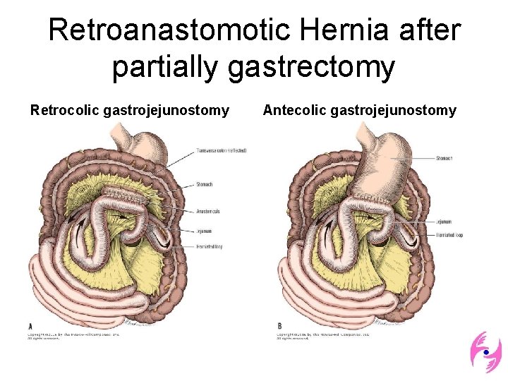 Retroanastomotic Hernia after partially gastrectomy Retrocolic gastrojejunostomy Antecolic gastrojejunostomy 