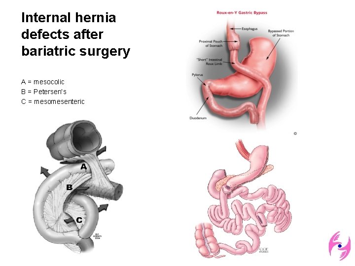 Internal hernia defects after bariatric surgery A = mesocolic B = Petersen’s C =
