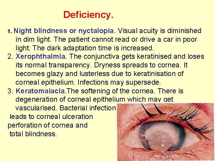 Deficiency. 1. Night blindness or nyctalopia. Visual acuity is diminished in dim light. The