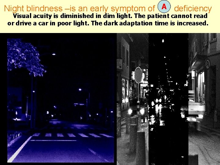 Night blindness –is an early symptom of A deficiency Visual acuity is diminished in