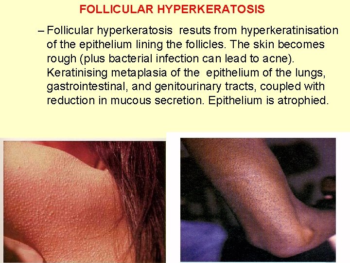 FOLLICULAR HYPERKERATOSIS – Follicular hyperkeratosis resuts from hyperkeratinisation of the epithelium lining the follicles.