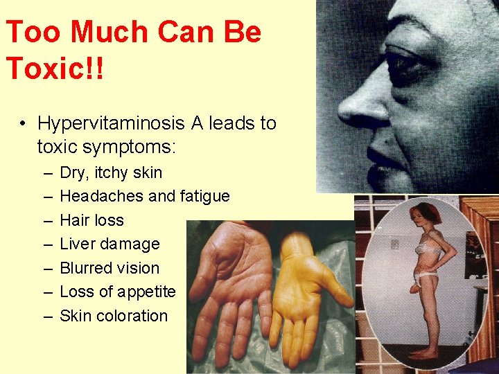 Too Much Can Be Toxic!! • Hypervitaminosis A leads to toxic symptoms: – –