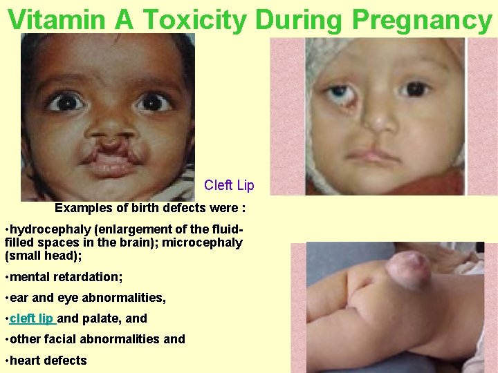 Vitamin A Toxicity During Pregnancy Cleft Lip Examples of birth defects were : •