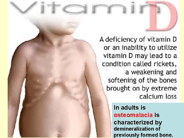 In adults is osteomalacia is characterized by demineralization of previously formed bone. 