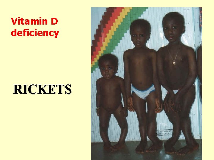Vitamin D deficiency RICKETS 