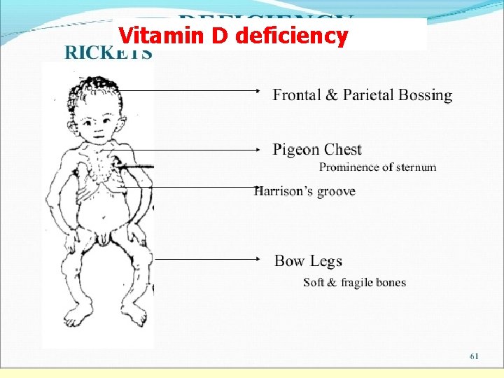Vitamin D deficiency 