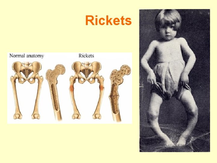 Rickets 