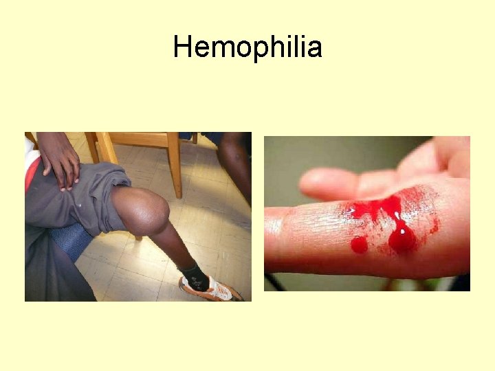Hemophilia 