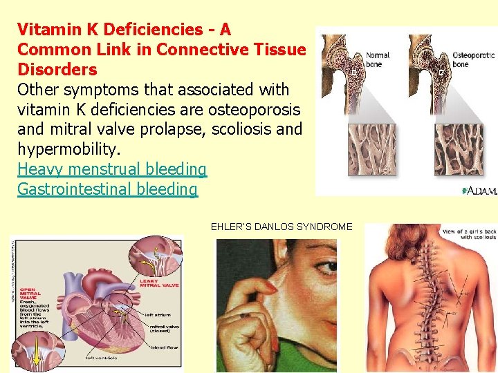 Vitamin K Deficiencies - A Common Link in Connective Tissue Disorders Other symptoms that