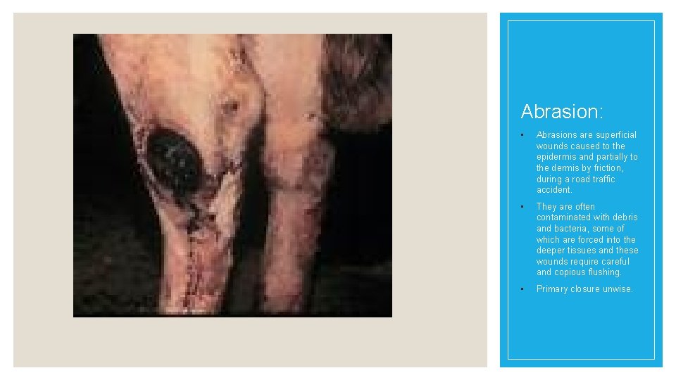 Abrasion: • Abrasions are superficial wounds caused to the epidermis and partially to the