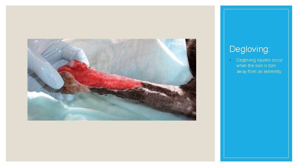 Degloving: • Degloving injuries occur when the skin is torn away from an extremity.