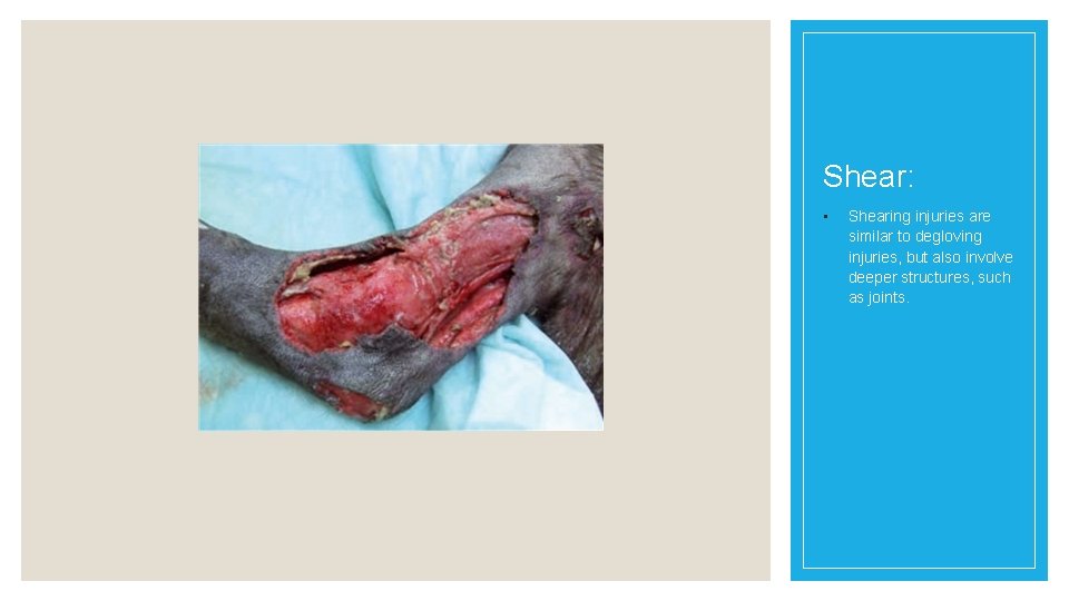 Shear: • Shearing injuries are similar to degloving injuries, but also involve deeper structures,