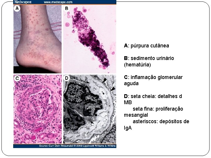 A: púrpura cutânea B: sedimento urinário (hematúria) C: inflamação glomerular aguda D: seta cheia: