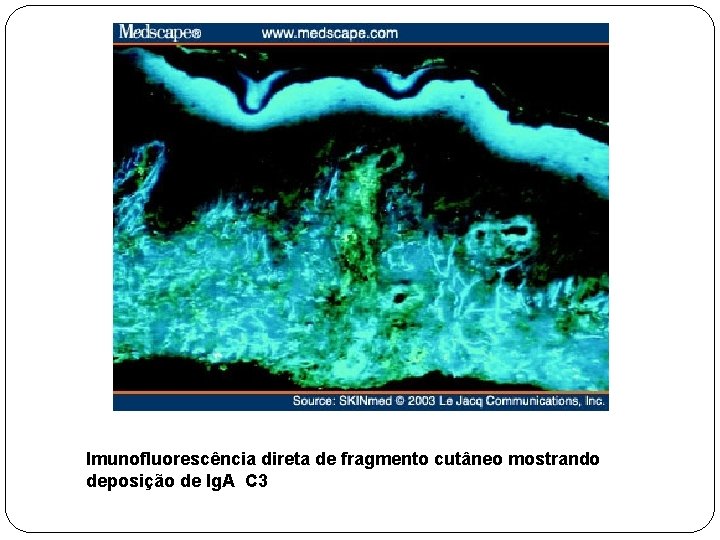 Imunofluorescência direta de fragmento cutâneo mostrando deposição de Ig. A C 3 