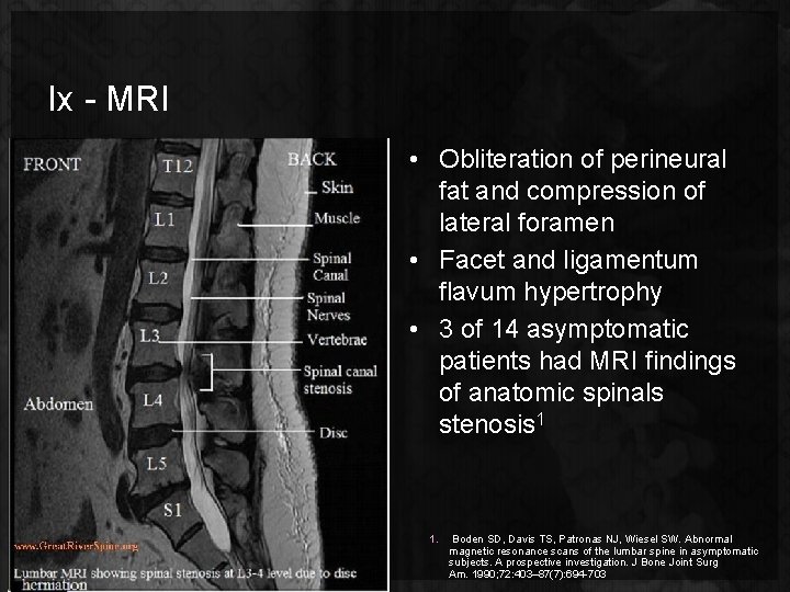 Ix - MRI • Obliteration of perineural fat and compression of lateral foramen •