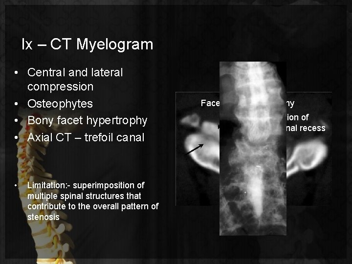 Ix – CT Myelogram • Central and lateral compression • Osteophytes • Bony facet