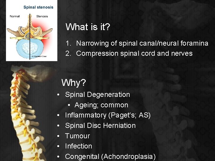 What is it? 1. Narrowing of spinal canal/neural foramina 2. Compression spinal cord and