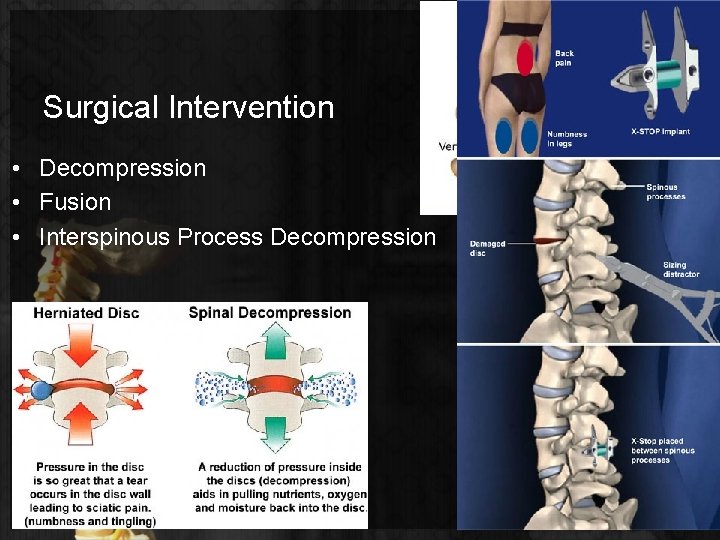 Surgical Intervention • Decompression • Fusion • Interspinous Process Decompression 