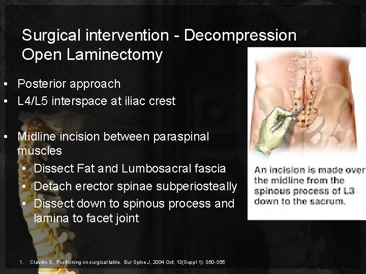 Surgical intervention - Decompression Open Laminectomy • Posterior approach • L 4/L 5 interspace