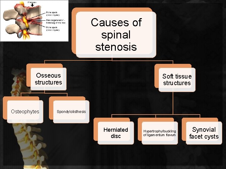 Causes of spinal stenosis Osseous structures Osteophytes Soft tissue structures Spondylolisthesis Herniated disc Hypertrophy/buckling