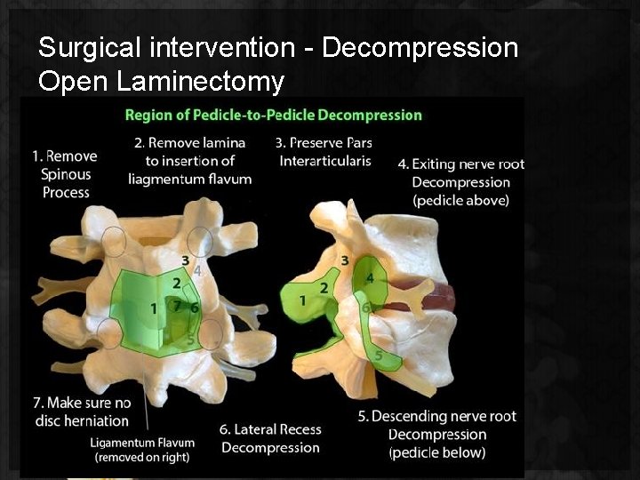 Surgical intervention - Decompression Open Laminectomy 