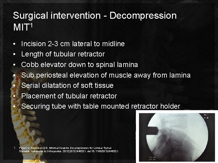 Surgical intervention - Decompression MIT 1 • • 1. Incision 2 -3 cm lateral
