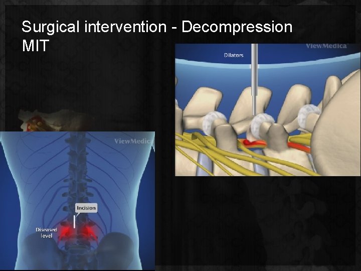 Surgical intervention - Decompression MIT 