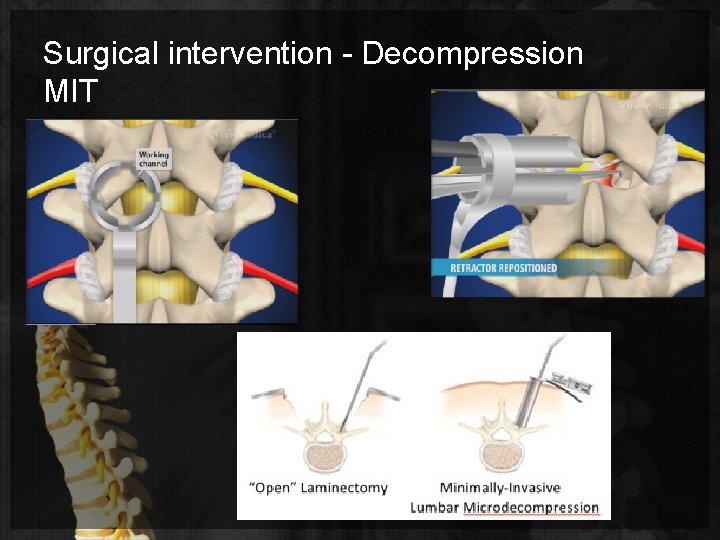 Surgical intervention - Decompression MIT 