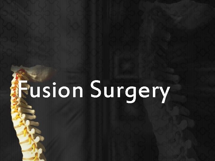 Fusion Surgery 