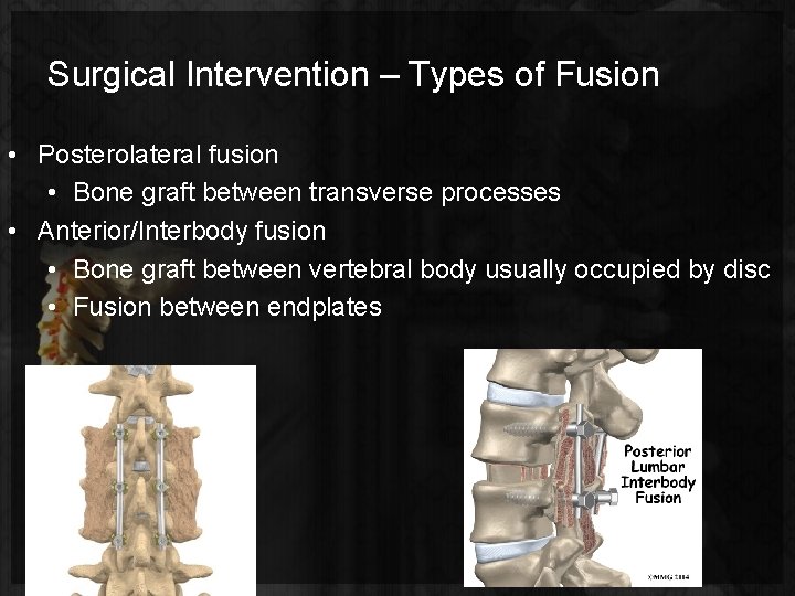 Surgical Intervention – Types of Fusion • Posterolateral fusion • Bone graft between transverse
