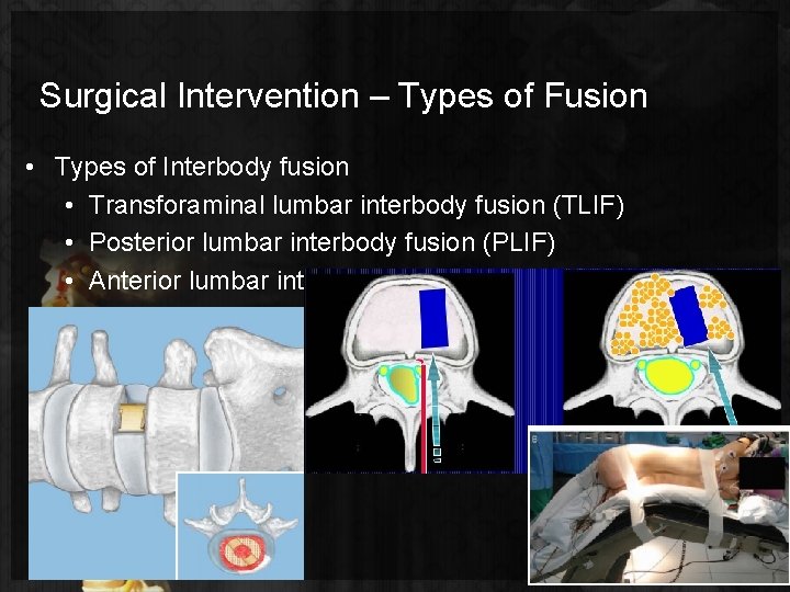 Surgical Intervention – Types of Fusion • Types of Interbody fusion • Transforaminal lumbar