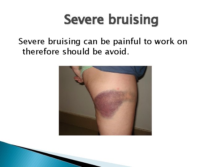 Severe bruising can be painful to work on therefore should be avoid. 