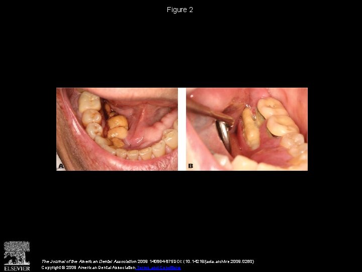 Figure 2 The Journal of the American Dental Association 2009 140864 -875 DOI: (10.