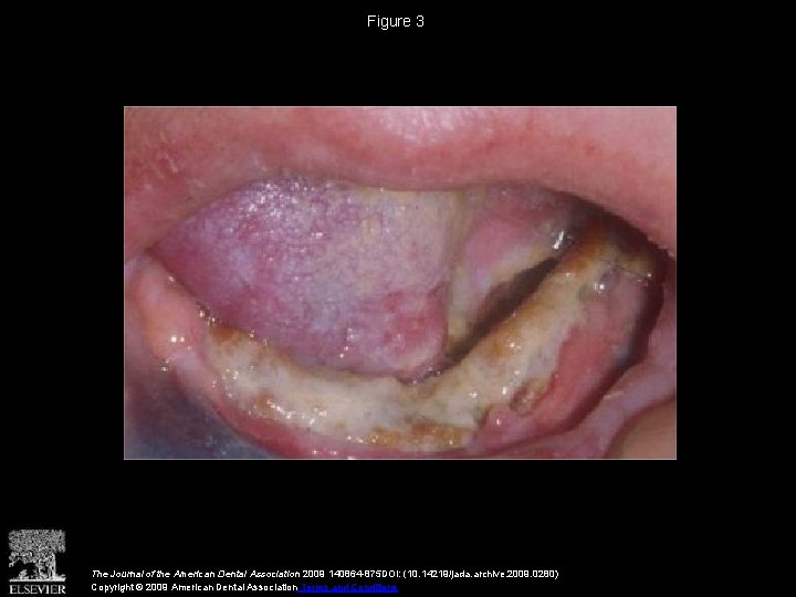 Figure 3 The Journal of the American Dental Association 2009 140864 -875 DOI: (10.