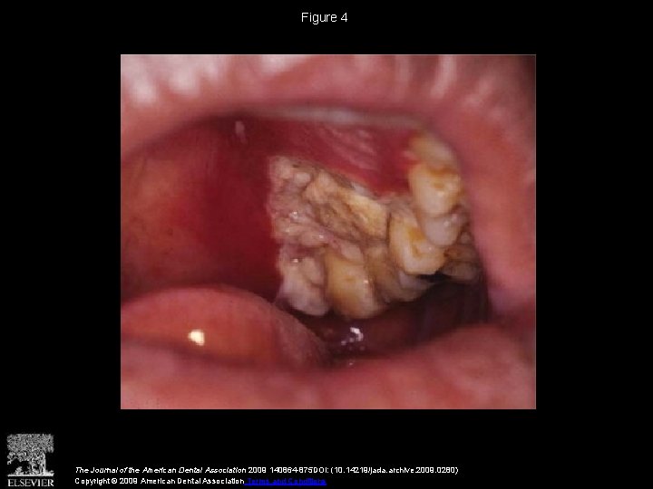 Figure 4 The Journal of the American Dental Association 2009 140864 -875 DOI: (10.