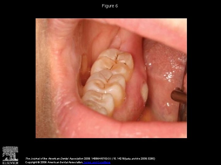 Figure 6 The Journal of the American Dental Association 2009 140864 -875 DOI: (10.