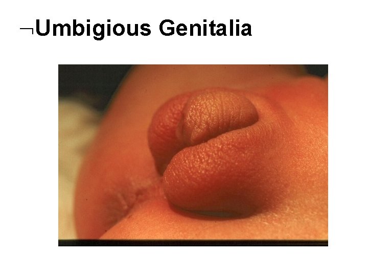  Umbigious Genitalia 