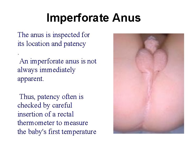 Imperforate Anus The anus is inspected for its location and patency. An imperforate anus