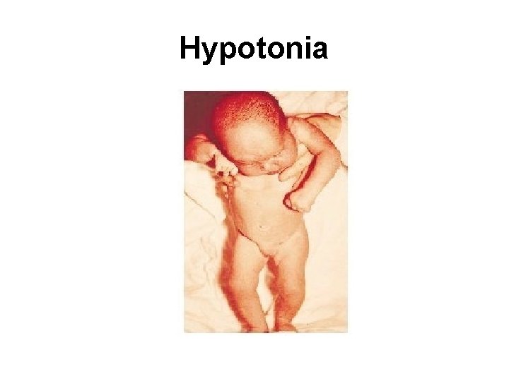 Hypotonia 
