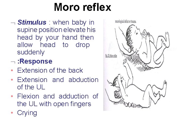 Moro reflex Stimulus : when baby in supine position elevate his head by your