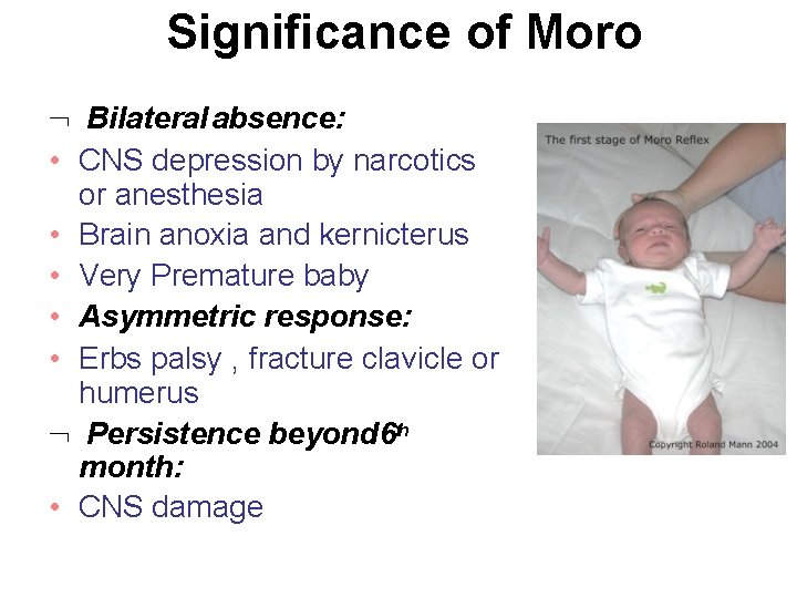Significance of Moro Bilateral absence: • CNS depression by narcotics or anesthesia • Brain