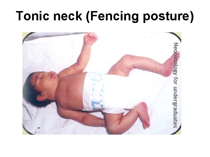 Tonic neck (Fencing posture) 