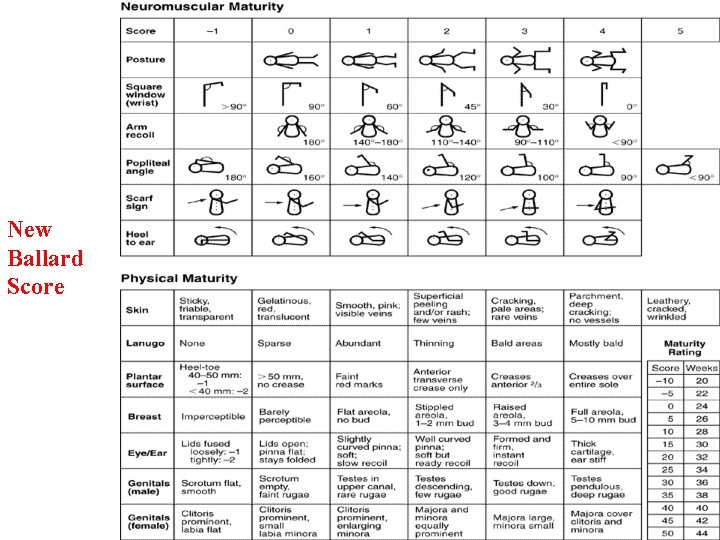 New Ballard Score Ballard JL, et al. JPediatrics; 1991: 119 (3) 