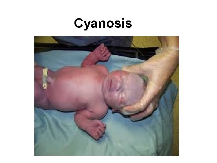 Cyanosis 